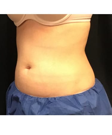 After Image: CoolSculpting – Abdomen - left-front-oblique