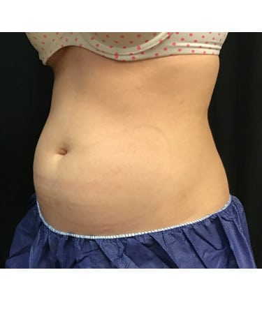 Before Image: CoolSculpting – Abdomen - left-front-oblique