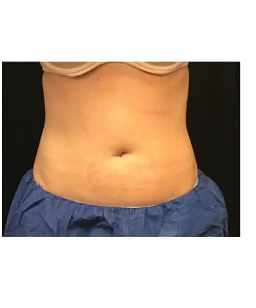 After Image: CoolSculpting – Abdomen - front
