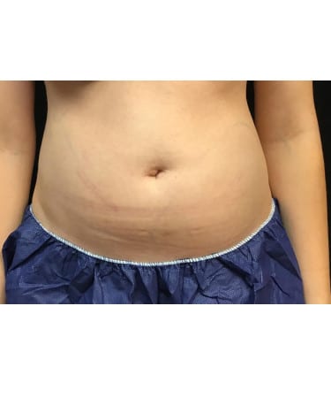 Before Image: CoolSculpting – Abdomen - front