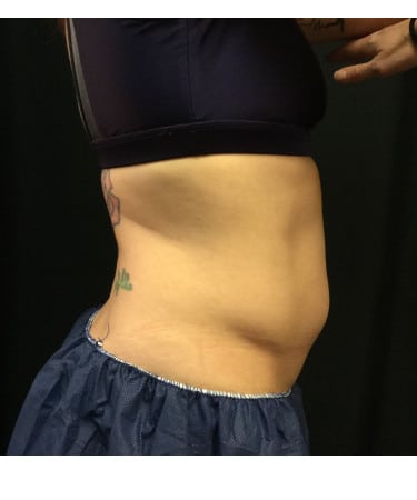 After Image: CoolSculpting – Abdomen - right-side