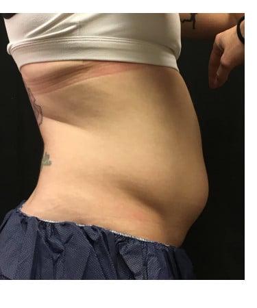 Before Image: CoolSculpting – Abdomen - right-side