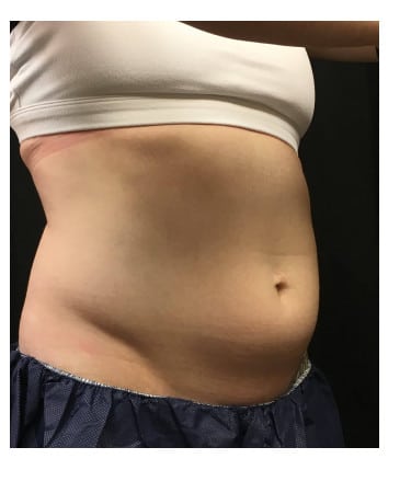 Before Image: CoolSculpting – Abdomen - right-front-oblique