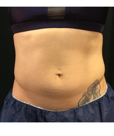 After Image: CoolSculpting – Abdomen - front