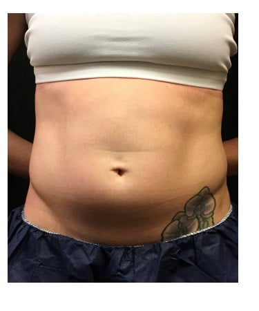 Before Image: CoolSculpting – Abdomen - front
