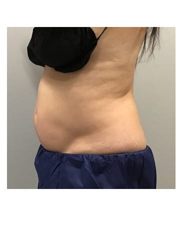 After Image: CoolSculpting – Abdomen - left-side