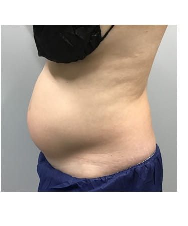 Before Image: CoolSculpting – Abdomen - left-side