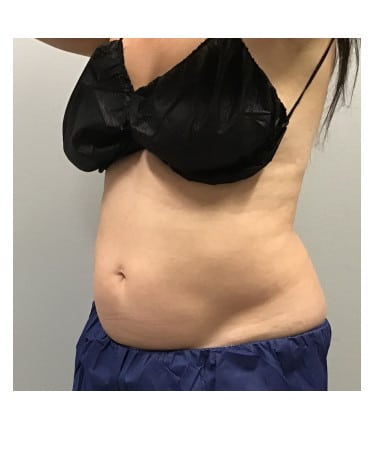 After Image: CoolSculpting – Abdomen - left-front-oblique