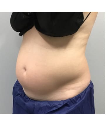 Before Image: CoolSculpting – Abdomen - left-front-oblique