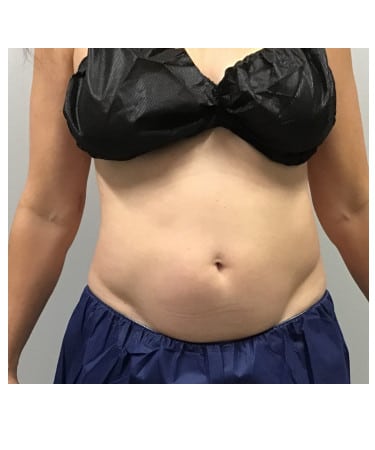 After Image: CoolSculpting – Abdomen - front