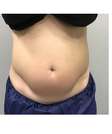 Before Image: CoolSculpting – Abdomen - front
