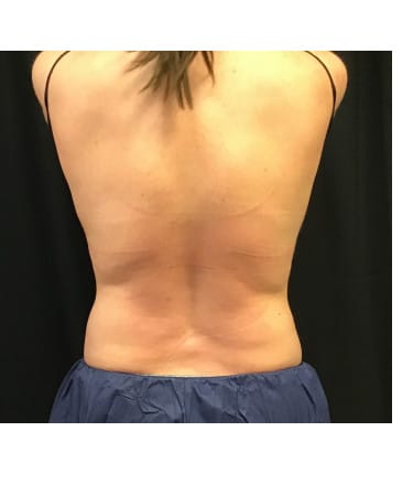 After Image: CoolSculpting – Flanks and Bra Strap Area - back