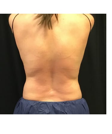 CoolSculpting - Flanks and Bra Strap Area Before & After Gallery