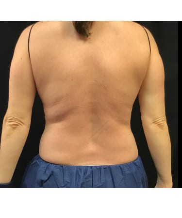 Before Image: CoolSculpting – Flanks and Bra Strap Area - back