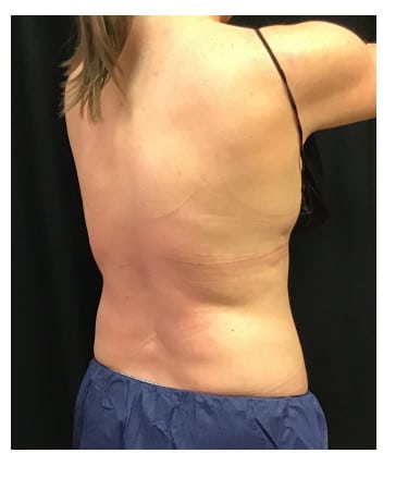 After Image: CoolSculpting – Flanks and Bra Strap Area - front