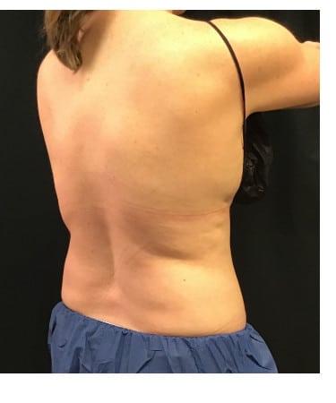 Before Image: CoolSculpting – Flanks and Bra Strap Area - front