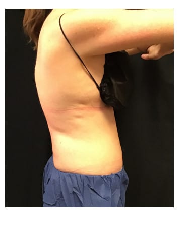 After Image: CoolSculpting – Flanks and Bra Strap Area - front