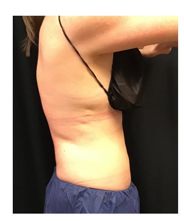 Before Image: CoolSculpting – Flanks and Bra Strap Area - front