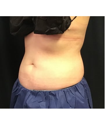 After Image: CoolSculpting – Abdomen - left-front-oblique