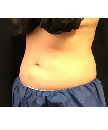 Before Image: CoolSculpting – Abdomen - left-front-oblique