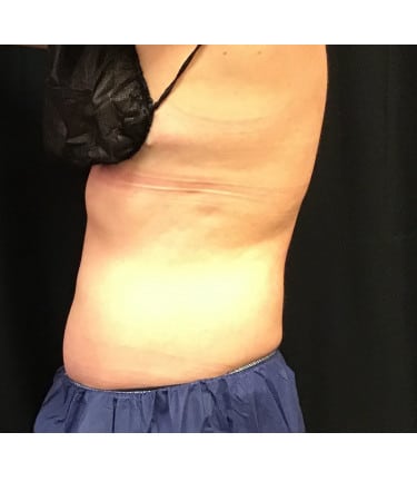 After Image: CoolSculpting – Abdomen - left-side