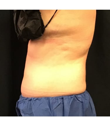 Before Image: CoolSculpting – Abdomen - left-side