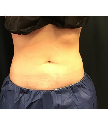 After Image: CoolSculpting – Abdomen - front