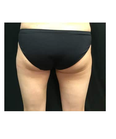 After Image: CoolSculpting – Inner Thigh - front