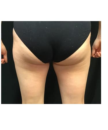 Before Image: CoolSculpting – Inner Thigh - front