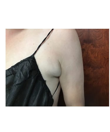 After Image: CoolSculpting – Axillary (armpit) Area - front