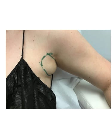Before Image: CoolSculpting – Axillary (armpit) Area - front