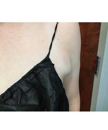 After Image: CoolSculpting – Axillary (armpit) Area - front