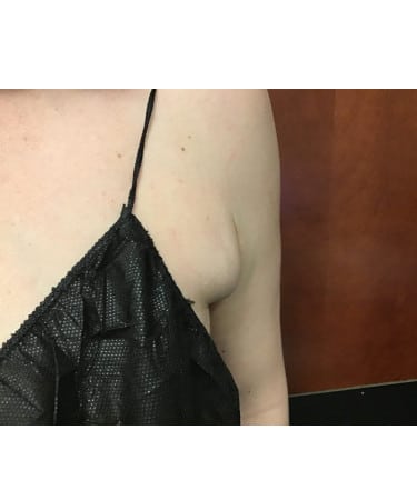 Before Image: CoolSculpting – Axillary (armpit) Area - front