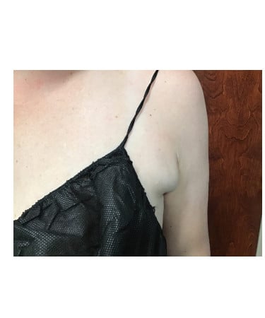 After Image: CoolSculpting – Axillary (armpit) Area - front