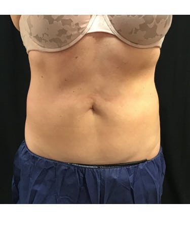 After Image: CoolSculpting – Upper & Lower Abdomen - front