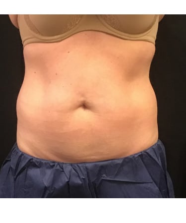 Before Image: CoolSculpting – Upper & Lower Abdomen - front