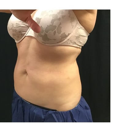After Image: CoolSculpting – Upper & Lower Abdomen - left-front-oblique