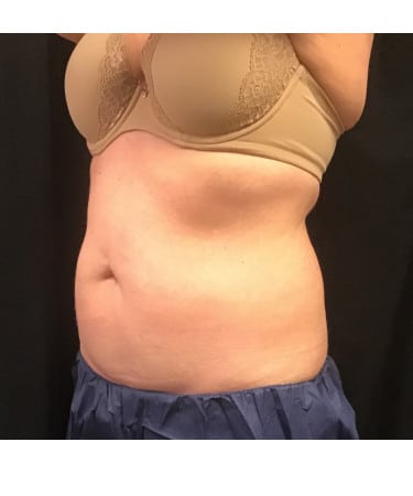 Before Image: CoolSculpting – Upper & Lower Abdomen - left-front-oblique