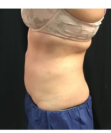 After Image: CoolSculpting – Upper & Lower Abdomen - front