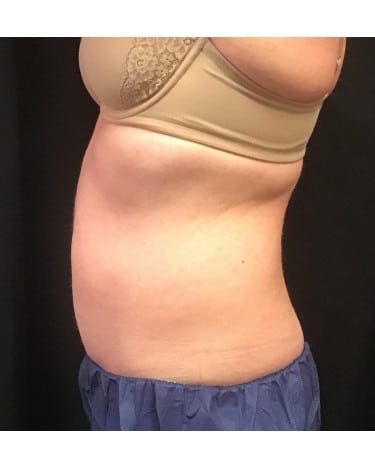 Before Image: CoolSculpting – Upper & Lower Abdomen - front