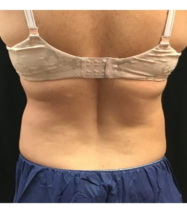 After Image: CoolSculpting – Flanks - back