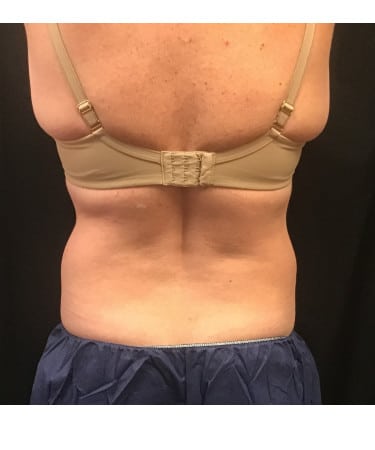Before Image: CoolSculpting – Flanks - back