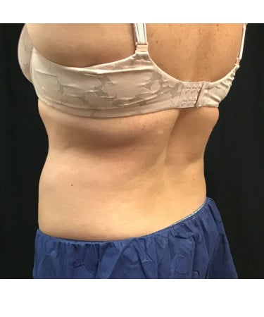 After Image: CoolSculpting – Flanks - left-front-oblique
