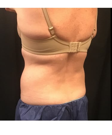 Before Image: CoolSculpting – Flanks - left-front-oblique