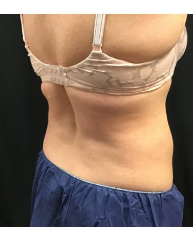 After Image: CoolSculpting – Flanks - front