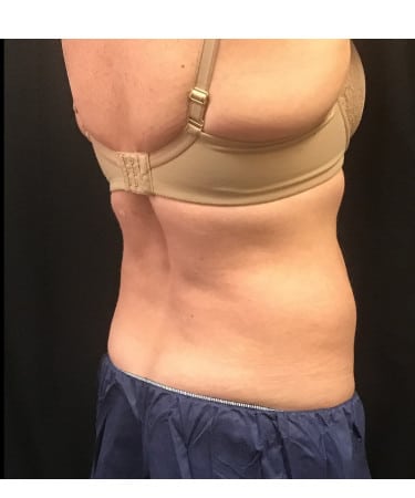 Before Image: CoolSculpting – Flanks - front