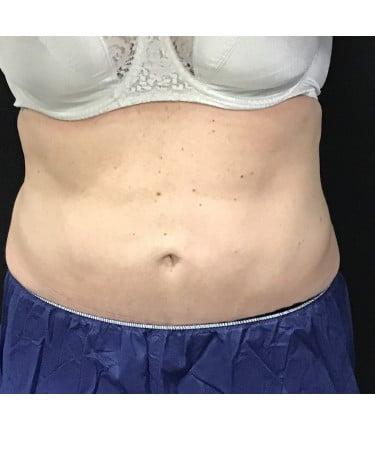 After Image: CoolSculpting – Abdomen - front