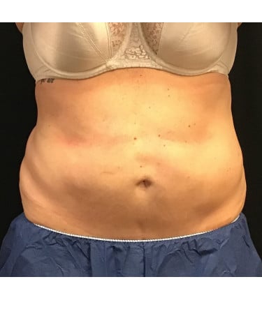 Before Image: CoolSculpting – Abdomen - front