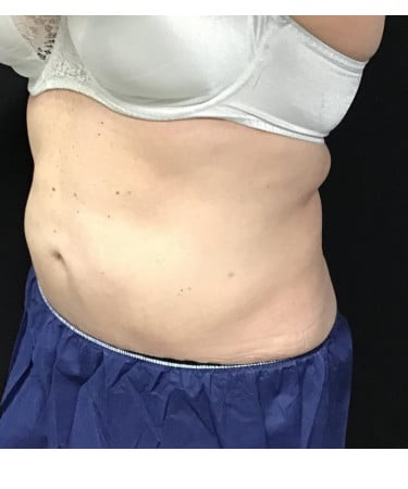 After Image: CoolSculpting – Abdomen - left-front-oblique