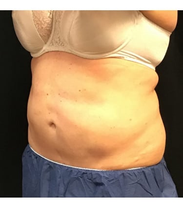 Before Image: CoolSculpting – Abdomen - left-front-oblique